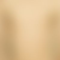 Epidermolysis bullosa junctionalis, non-Herlitz. 12-year-old female patient with generalized clin...