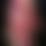 Epidermolysis bullosa junctionalis, non-Herlitz. Hier abgebildet ist ein Abheilungszustand mit bi...