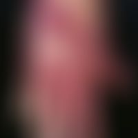 Epidermolysis bullosa junctionalis, non-Herlitz. shown here is a healing state with bizarrely con...