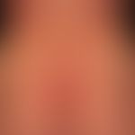 Epidermolysis bullosa junctionalis, non-Herlitz: poikilodermatisches Bild mit flächigen Vernarbun...
