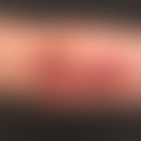 Epidermolysis bullosa junctionalis, non-Herlitz: poikilodermaticpicture with extensive atrophic s...