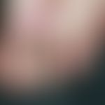 Epidermolysis bullosa dystrophica praetibialis: Nail discoloration and nail dystrophies with spot...