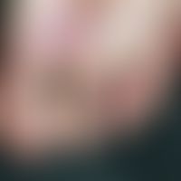 Epidermolysis bullosa dystrophica praetibialis: Nail discoloration and nail dystrophies with spot...