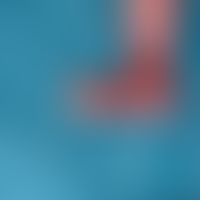 Epidermolysis bullosa dystrophica dominans: Sharp-edged skin detachment at the right foot of the ...