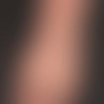 Epidermolysis bullosa dystrophica dominans
