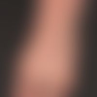 Epidermolysis bullosa dystrophica dominans
