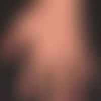 Epidermolysis bullosa dystrophica dominans
