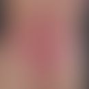 Epidermolysis bullosa dystrophica inversa. Ausgeprägte Blasenbildung bei einer 32-jährigen Patien...