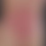 Epidermolysis bullosa dystrophica inversa. Ausgeprägte Blasenbildung bei einer 32-jährigen Patien...