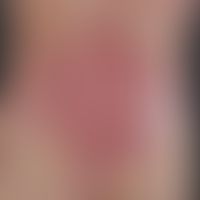 Epidermolysis bullosa dystrophica inversa. Ausgeprägte Blasenbildung bei einer 32-jährigen Patien...