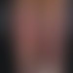 Epidermolysis bullosa dystrophica inversa. Ausgeprägte Blasenbildung bei einer 32-jährigen Patien...