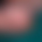 Epidermolysis bullosa simplex, Dowling-Meara. In Abheilung begriffene Blase bei einem 2 Monate al...