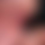 Epidermolysis bullosa simplex, Dowling-Meara. Identische Hautveränderungen am 4. Finger der li. H...
