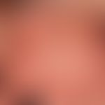 Epidermolysis bullosa simpex, Weber-Cockayne:&nbsp;Epidermolysis bullosa simpex, Weber-Cockayne: ...