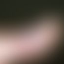 Epidermolysis bullosa simplex, Köbner. Pralle, eingeblutete, subepidermal gelegene Blase im Berei...