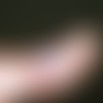 Epidermolysis bullosa simplex, Köbner. Pralle, eingeblutete, subepidermal gelegene Blase im Berei...