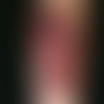 Epidermolysis bullosa simplex, Köbner. Multiple, seröse oder hämorrhagische Blasen unterschiedlic...