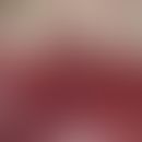 epulis. chronic stationary, slightly pressure sensitive, polypose, smooth lump in region 42-44 fo...