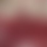 epulis. chronic stationary, slightly pressure sensitive, polypose, smooth lump in region 42-44 fo...