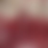 epulis. chronic stationary, slightly pressure sensitive, polypose, smooth lump in region 42-44 fo...