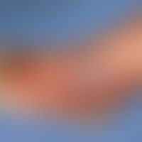Erysipelas. hemorrhagic blistering and erosions on sharply defined erythema in the area of the fo...