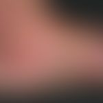 Sharply limited redness on the left inner side of the foot with hemorrhagic blistering and honey-...