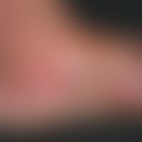 Sharply limited redness on the left inner side of the foot with hemorrhagic blistering and honey-...