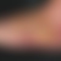 Erysipelas: Sharply limited redness along the left back of the foot and the outer side of the foo...