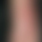 erysipelas. extensive redness and swelling of the left foot in a 71-year-old man. on the left bac...