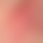 Erysipelas. acutely appeared, blurred, laminar redness and swelling, on the right side nasal and ...