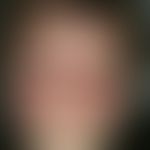 Erysipelas. circumscribed, fiery red, sharply defined erythema with extensive swelling of the ski...