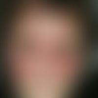 Erysipel:&nbsp;zirkumskripte, feuerrote, scharf begrenzte (symmetrische!)&nbsp;Schwellung . Deutl...