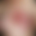 Erysipelas: Solitary, acute, increasing for 4 days, blurred (with runners), flat, clearly increas...