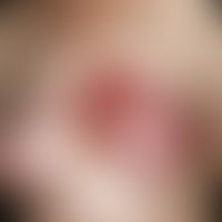 Erysipel:&nbsp;unter hohem Fieber einhergehende, solitäre, akute, seit wenigen&nbsp;Tagen bestehe...