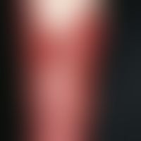 erysipelas. solitary, acutely occurring, extensive, sharply defined, red plaque and bulging blist...
