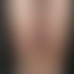 Erysipelas. edema of both lower legs and back of the foot with redness and overheating, here in c...