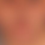 Erysipelas, acute: a sharply defined, flat, rich redness and swelling of the skin of the lower ja...