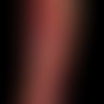 Erysipelas, acute: a sharply defined, flat, rich reddening of the lower leg under high fever with...