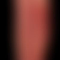 Erysipel, akutes: unter hohem Fieber aufgetretene, scharf begrenzte flächige, satte Rötung&nbsp;d...