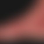 Erysipelas. painful redness and swelling of the left foot in a 65-year-old man with fever. In add...