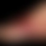 Erysipelas, acute acute reddening of the back of the foot under high fever, sharply limited and e...