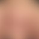 Erysipelas carcinomatosum. Scharf begrenzte, livid-rötliche, derbe, großflächige Plaque im Brustb...