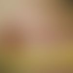 Erysipelas carcinomatosum. Zungenförmig auslaufende, scharf begrenzte Rötung im Bereich der Amput...