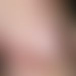Erysipelas carcinomatosum. Scharf und zackig begrenzte, gerötete, überwärmte, evtl. druckdolente,...