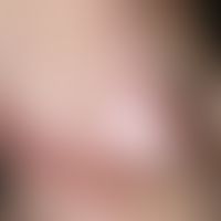 Erysipelas carcinomatosum. Scharf und zackig begrenzte, gerötete, überwärmte, evtl. druckdolente,...