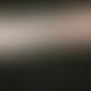Erysipeloid. Multiple, chronisch dynamische, asymmetrische, disseminierte, 3,0-6,0 cm große, rund...