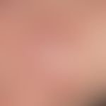 Erythema anulare centrifugum. Nahaufnahme: Randbetonte im Randbereich deutlich erhabene, erythema...