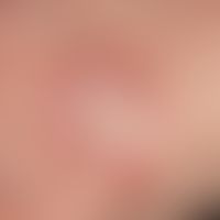 Erythema anulare centrifugum. close-up: prominent raised erythematous plaque on the back of the h...