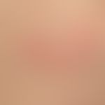 Erythema anulare centrifugum. Detailaufnahme: Deutlich randbetonte (gut palpabler Rand) und zentr...
