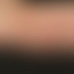 Erythema anulare centrifugum. Großflächige, polyzyklisch begrenzte, schuppende Erytheme mit elevi...